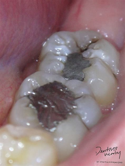 What're Amalgam and Composite Restorations?