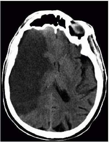 Hemorrhagic Stroke - Net Health Book