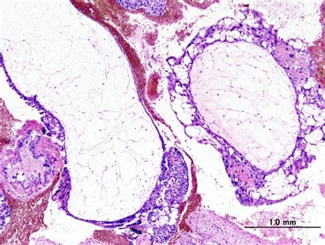 Hydatidiform Mole - Reproductive - Medbullets Step 1