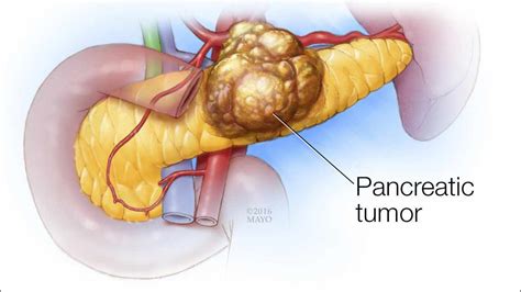 Pancreas Cancer