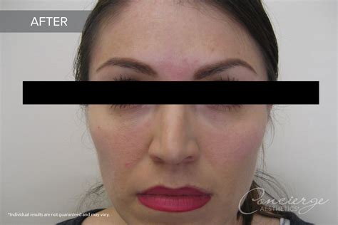 B and A - Juvederm Ultra Under Eyes (37 yo) | Concierge Aesthetics