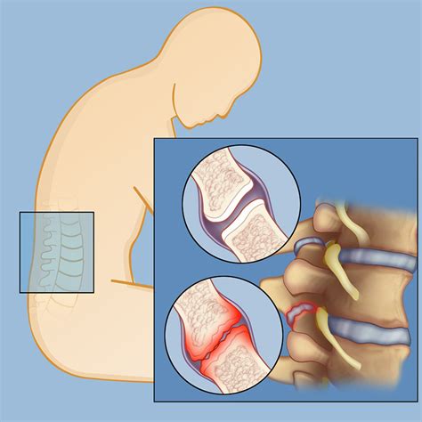 Facet Syndrome | Brain & Spine Center