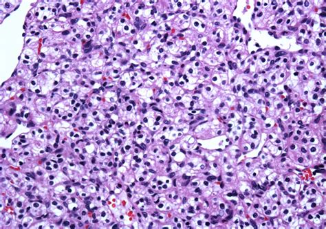 neuropathology blog: A case of renal cell carcinoma metastatic to a ...