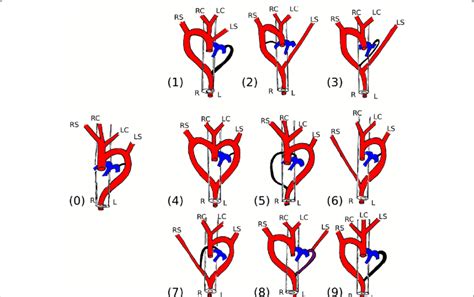 Classification scheme for aortic arch anomalies leading to a vascular ...