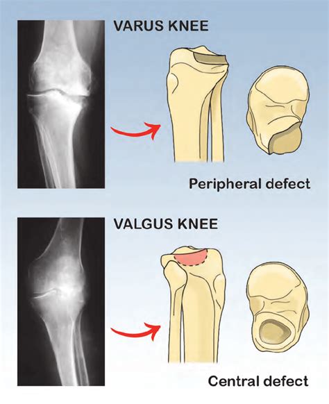 Varus deformity of knee treatment | doctorvisit