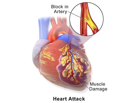 What is Angina? Symptoms, Causes, Prevention & Complications and Risk factors of Angina ...