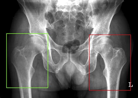 Detection and localisation of hip fractures on anteroposterior radiographs with artificial ...