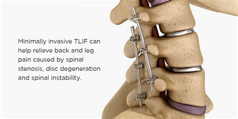 What is TLIF Surgery? | New York Spine Institute