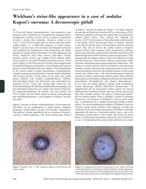 (PDF) Wickham's striae-like appearance in a case of nodular Kaposi's ...