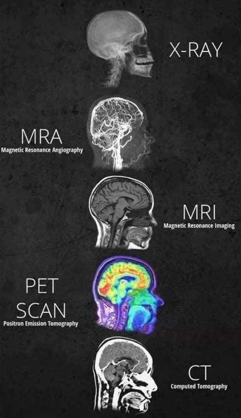 X-Ray : MRA : MRI : PETCT : CT Scan Image compared... | 基礎医学, 学習ノート, 理学療法