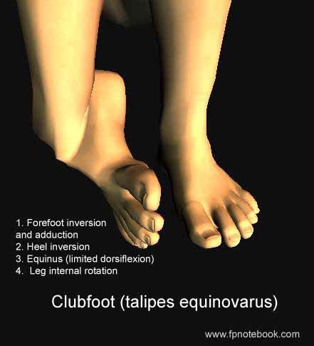 Physical Therapy Exercises: club foot