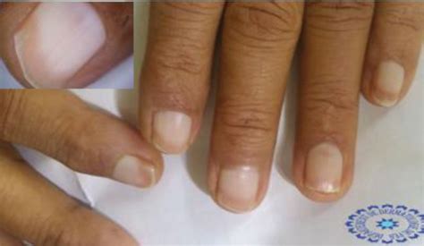 Nail Disorders in Patients with Chronic Renal Failure