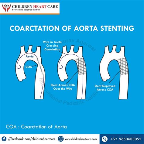 Coarctation of Aorta Treatment in Delhi - Dr. Gaurav Agrawal