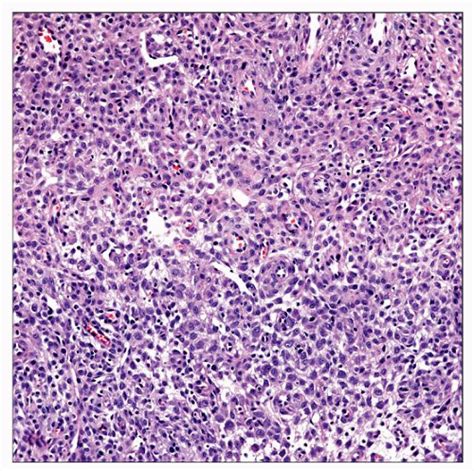 Histiocytoma Histology