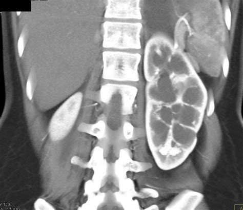 Unusual case with Malrotated Right Kidney and Dilated Calyceas Left ...