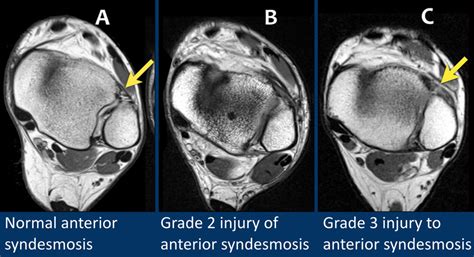 High Ankle Sprain Mri