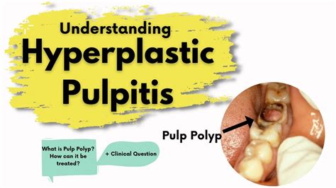 Pulp Polyp (Hyperplastic Pulpitis) | What is it? | Diagnosis, Treatment | Endodontics - YouTube