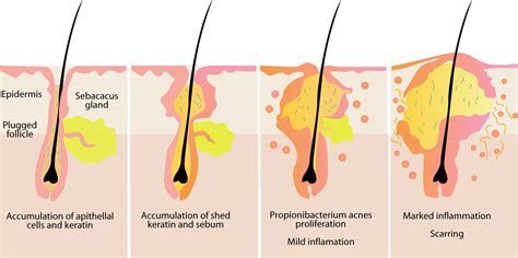 Sebaceous Glands - Location, Functions and Pictures