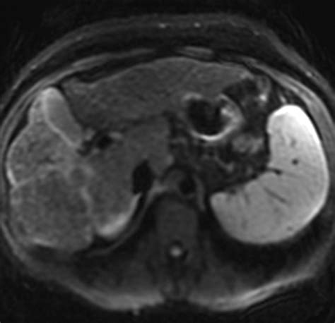 MR Imaging of Liver Fibrosis: Current State of the Art | RadioGraphics