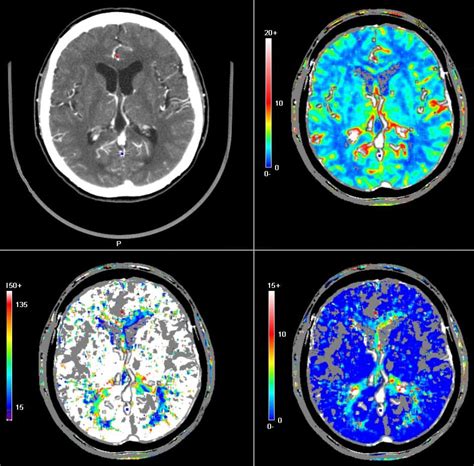 Brain Jack Image: Brain Ct Scan