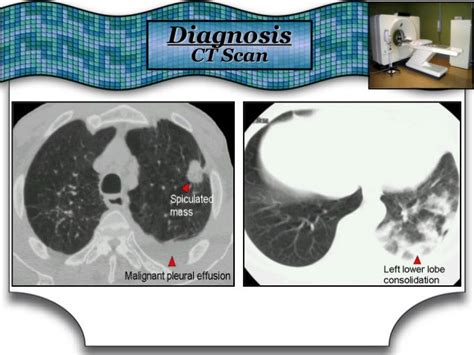 Hemoptysis