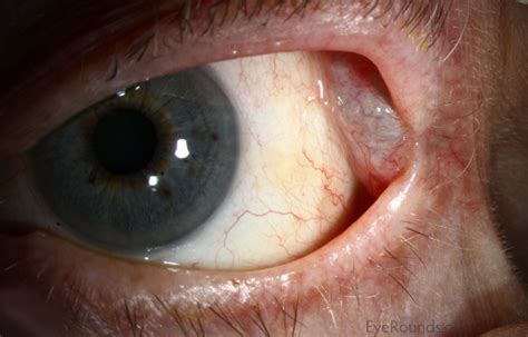 Atlas Entry - Lacrimal gland dacryops