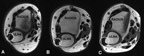 Subluxation of the distal extensor carpi ulnaris (ECU) tendon. Axial... | Download Scientific ...