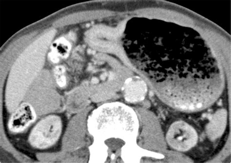 Computed tomography of the abdomen before surgery. Computed tomography ...