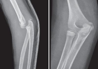 Clinical Practice Guidelines : Elbow Dislocations - Emergency Department