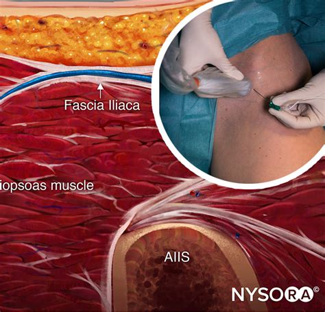 Ultrasound-Guided Fascia Iliaca Nerve Block - NYSORA | NYSORA