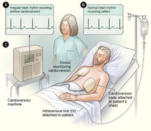 Cardioversion - Baltimore Cardiologists - Woodholme Cardiovascular Associates