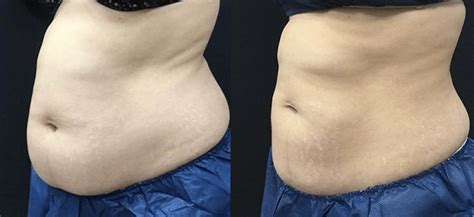 Part Two: Check Out Michelle's CoolSculpting Results