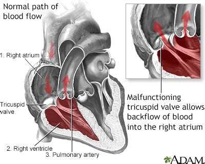 Disease - Tricuspid regurgitation