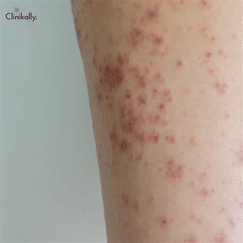 Skin Rashes: Causes, Symptoms, and Treatment | Clinikally