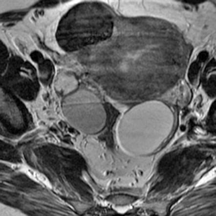 Endometrioma | Radiology Reference Article | Radiopaedia.org