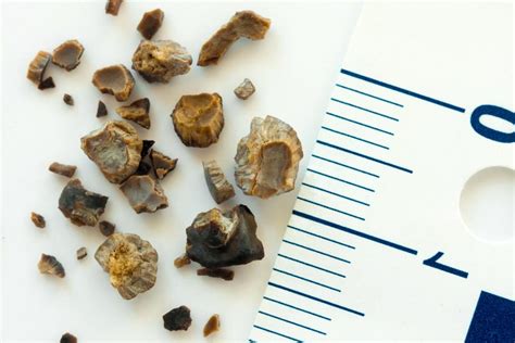 Learn About Kidney Stones | Yakima Urology Associates PLLC