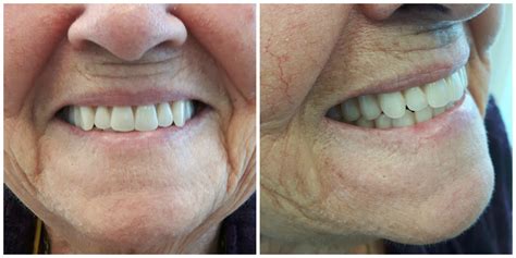 Complete Upper & Lower Dentures | Kelowna Denture Clinic