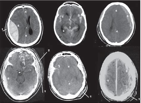 1, extracranial soft-tissue swelling; 2, depressed bone fracture; 3 ...