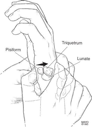 Lunotriquetral Instability | Musculoskeletal Key