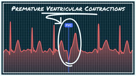 What Premature Ventricular Contraction (PVC) Looks Like on Your Watch ECG | Qaly