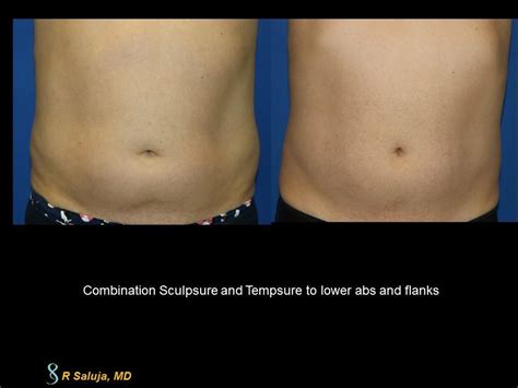 Sculpsure Laser Treatment Fat Reducer: Saluja Cosmetic and Laser Center ...