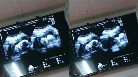 Congenital anomaly scan / 2nd ultrasound at 27 weeks / You will see my face here - YouTube