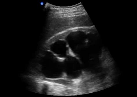 Renal Images | Emergency Ultrasonography