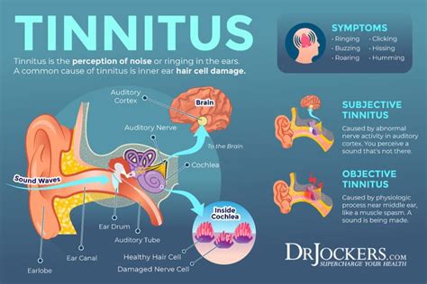 Tinnitus: Symptoms, Causes and Natural Support Strategies in 2021 | Tinnitus symptoms, Tinnitus ...