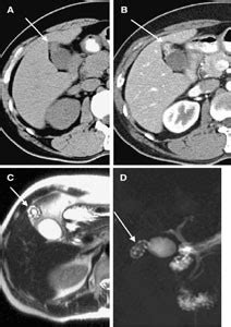 Gallbladder adenomyomatosis: imaging findings | SpringerLink