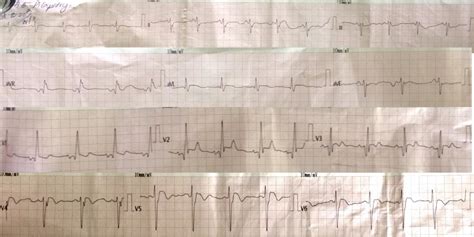 ECG #9 RVH with or without? | TiCME Time Critical Medical Education