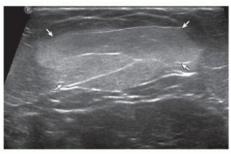 Lipoma. Ultrasound image shows oval hyperechoic subcutaneous lipoma (arrows) with internal ...