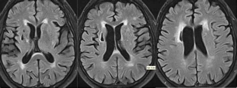 The Role of MRI and DaTscan in Vascular Parkinsonism: A Case Report - MDS Abstracts