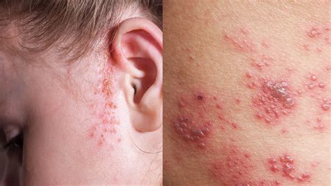 10 Rashes That Could Reveal a Dermatologic Disease » | Types of rashes, Psoriasis rash ...