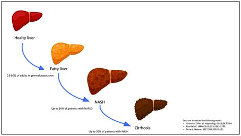 Progression of non-alcoholic fatty liver disease (NAFLD). The stages of ...